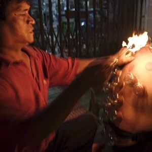 Fire cupping performed on a tourist