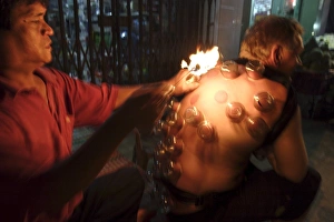 Can Tho Prints: Fire cupping performed on a tourist
